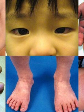 สกสว. เผยข้อมูล “อันตรายของโรคโควิด-19 ที่อาจเกิดขึ้นกับเด็ก”