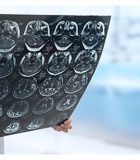 รู้จักกับเนื้องอกสมอง และวิธีวางแผนรับมือหากเนื้องอกเป็นเนื้อร้ายที่เรียกว่า “มะเร็ง”เนื่องในวันเนื้องอกสมองโลก 8 มิ.ย.